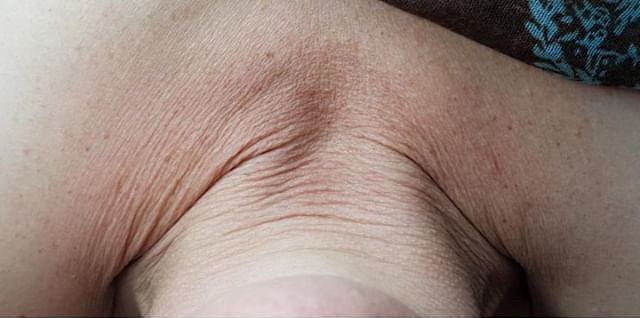 Voor behandeling nek